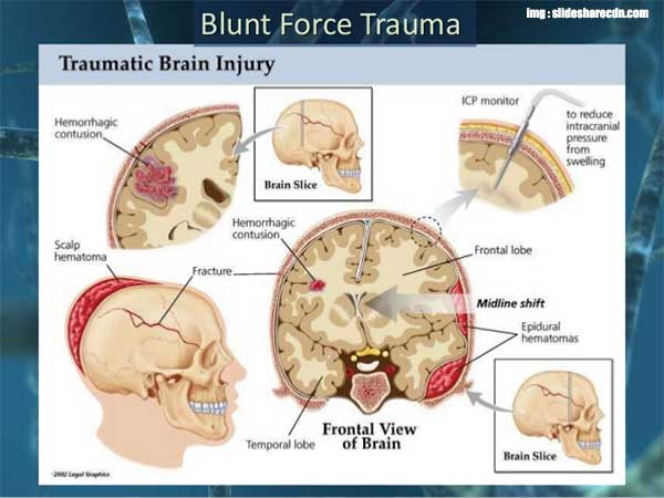 Blunt Force Trauma