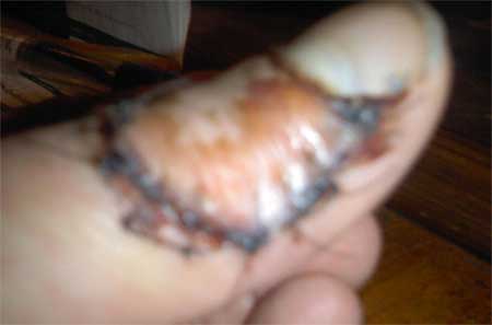 Crossbow Safety Injured Thumb