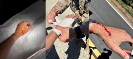 Images of injury inflicted on ICE employee after being doxed by Rep. Carbajal